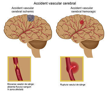 Accidentul vascular cerebral